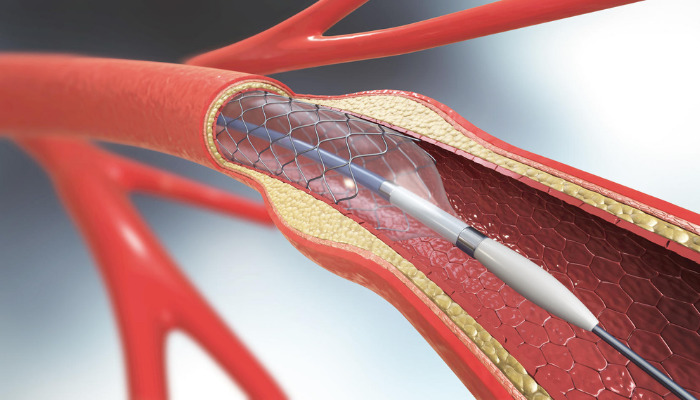 Blutgefäß Stent