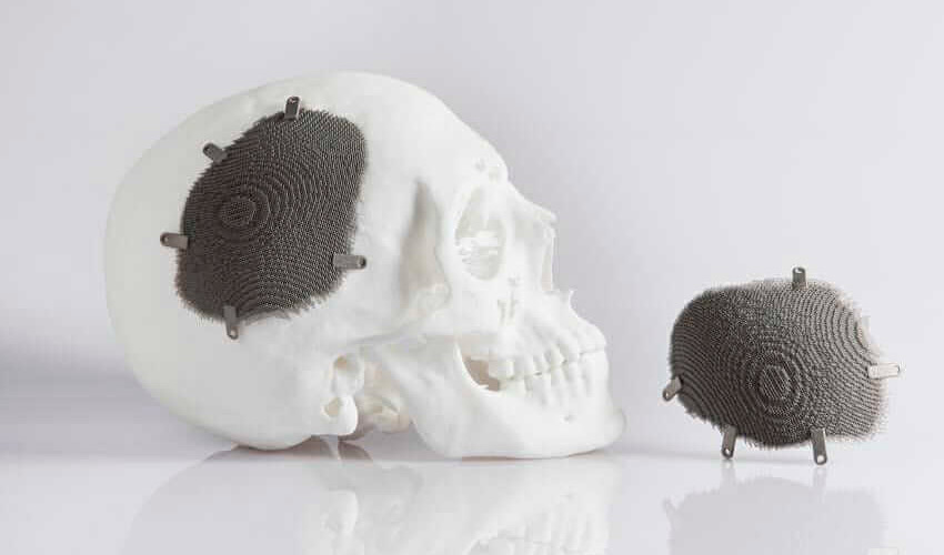3D-gedruckte Implantate