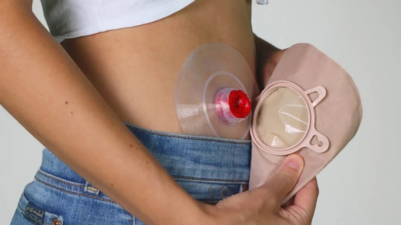 Odapt ist die 3D-gedruckte Scheibe fr Stoma-Beutel, die keine undichten  Stellen verursacht - 3Dnatives