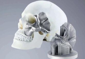 3D-gedruckte Implantate