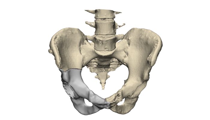 3D-gedruckte Implantate