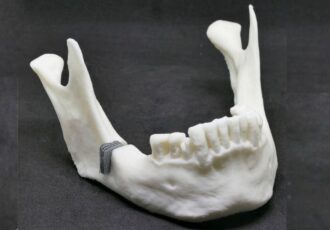 Knochenimplantat Gitterstruktur