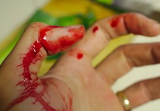 Biotinte PAINT soll Wundheilung beschleunigen
