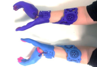 3D-gedruckte Orthesen