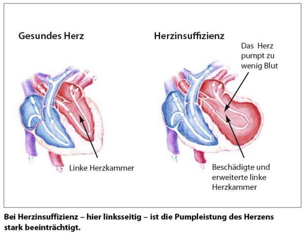 herz aus 3D-Drucker