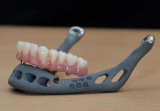 3D-gedrucktes Implantat des Unterkiefers