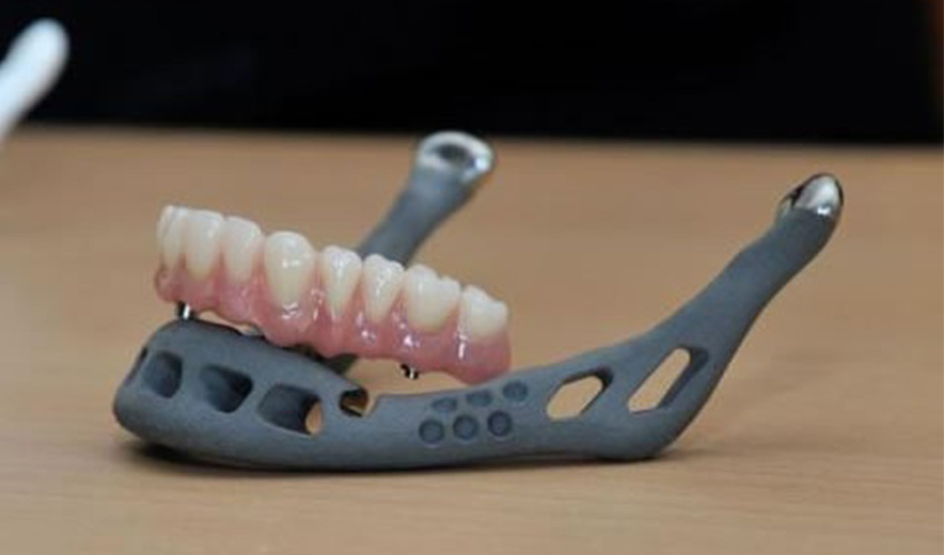 3D-gedrucktes Implantat des Unterkiefers