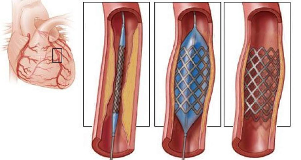 Stent