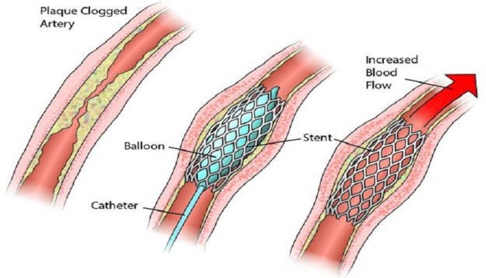 NewGen-Stent