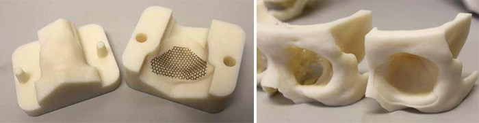 3D printed implants