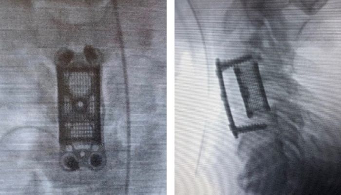 3D printed implants