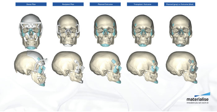 Materialise Double Transplant 