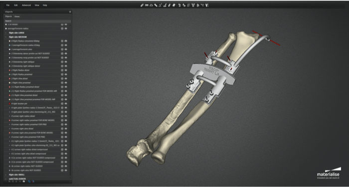 Materialise Double Transplant