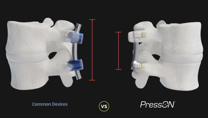 Nexus Spine's PressON