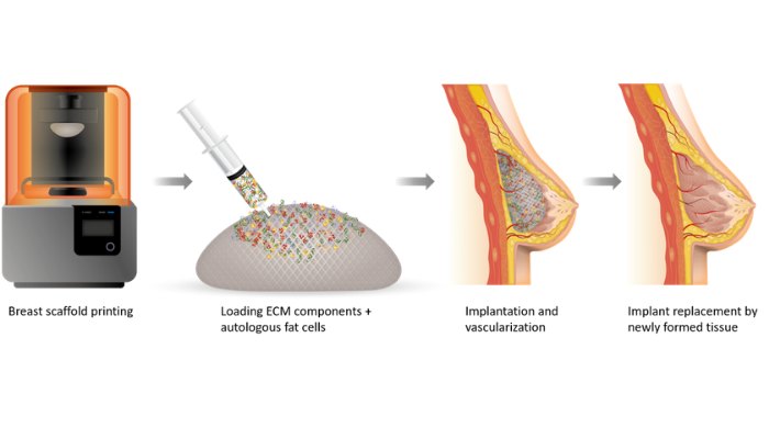 3D bioprinted breast reconstruction.