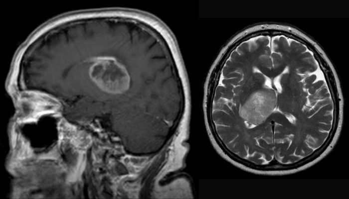 3D-printed tumor