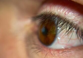 First Ever 3D Printed Eye Prosthetic