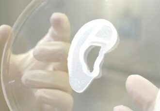 3D printed ear transplant