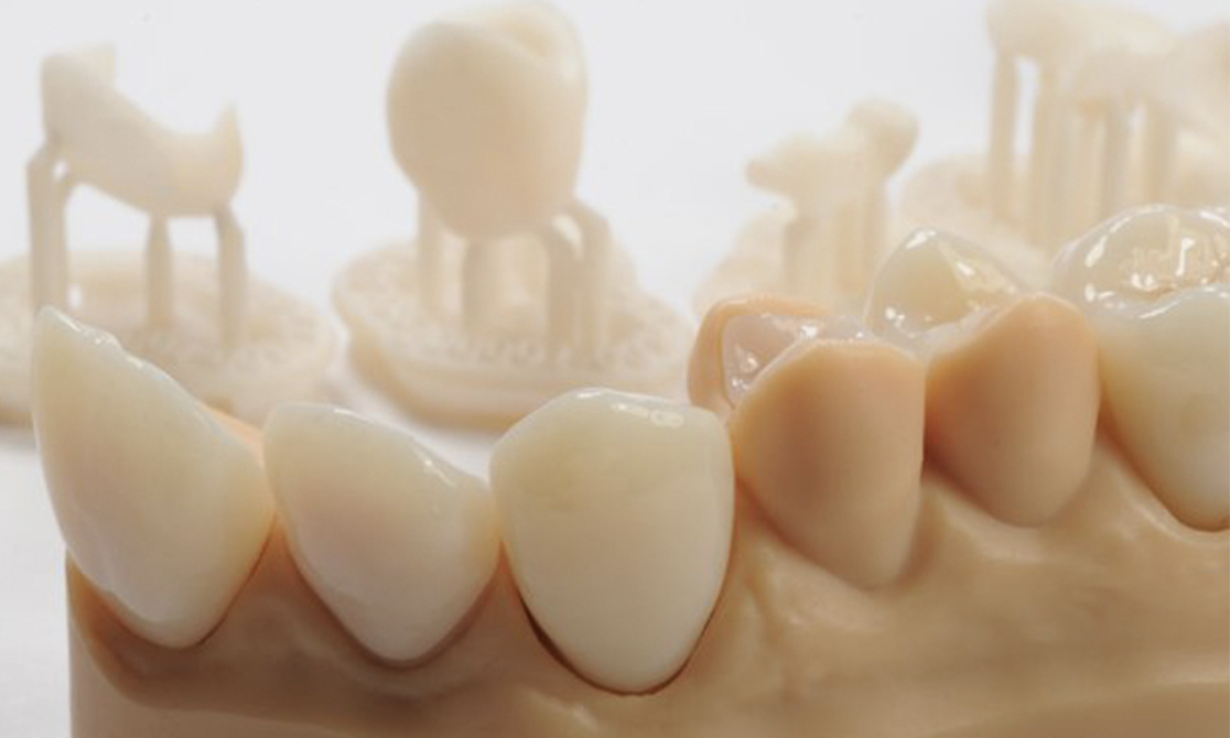 Image shows 3D printed dental crowns