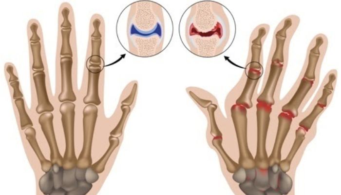 Comparaison des mains saines et arthritiques (peut-être adapté aux implants imprimés en 3D).
