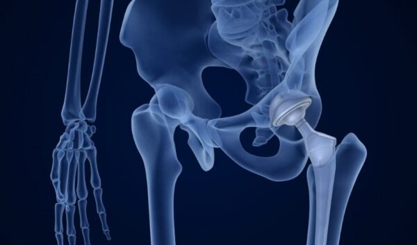 3D Printed Antibacterial Scaffolds for Bone Regeneration - 3Dnatives