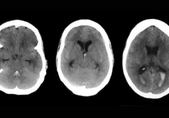brain aneurysms 3D printing