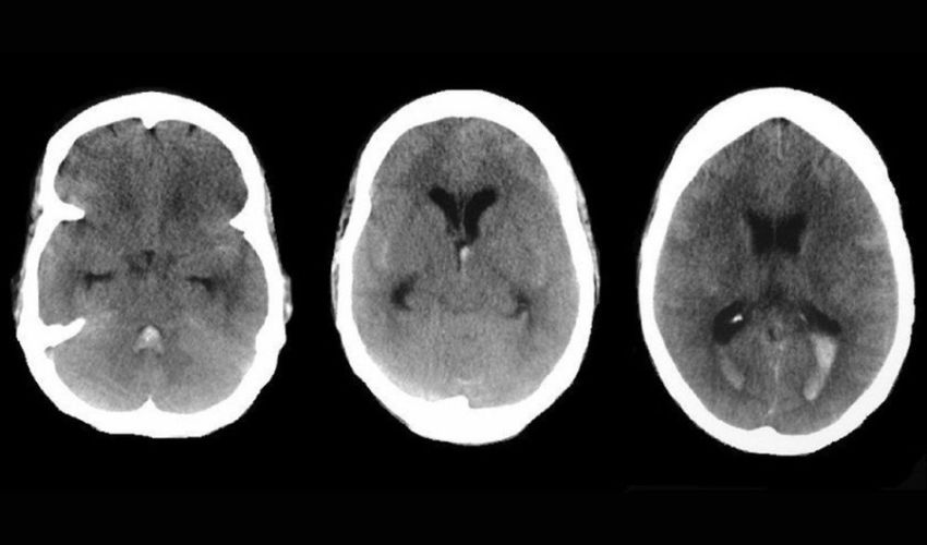 brain aneurysms 3D printing