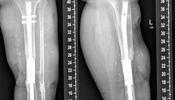 Custom 3D Printed Cage Successfully Treats Infected Tibial Shaft ...