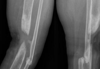 Custom 3D printed implant for patients fractured tibia shaft