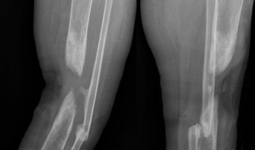 Custom 3D printed implant for patients fractured tibia shaft