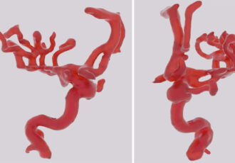 3D printing blood vessels in the brain