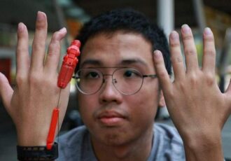 Engineer student gets 3Dprinted finger