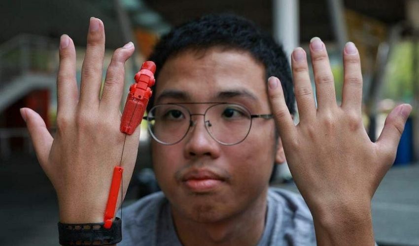 Engineer student gets 3Dprinted finger