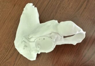 3D printed hip prosthesis