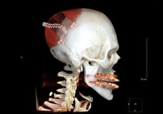 3D printed cranial prosthesis