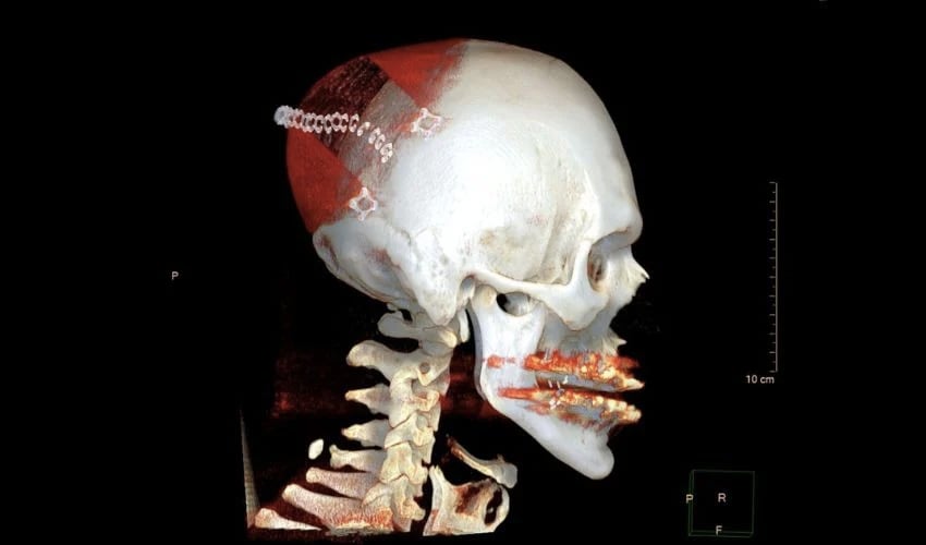 Einem Patienten wurde eine 3D-gedruckte Schädelprothese implantiert