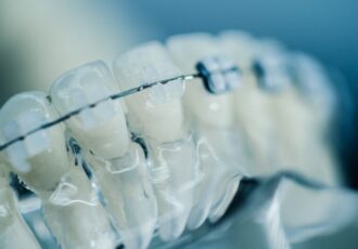 3D printed braces