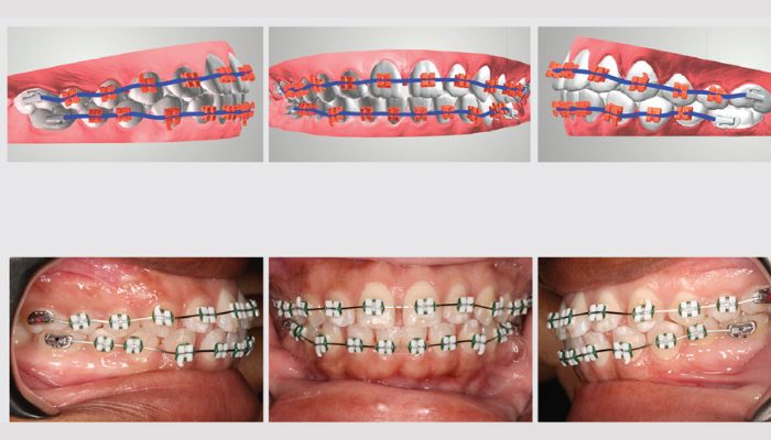 Digital workflows and AI-based software is critical to the creation of the personalized, 3D printed braces