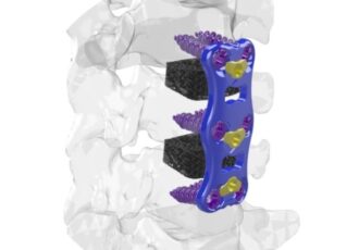 3D Printed Cervical Cage