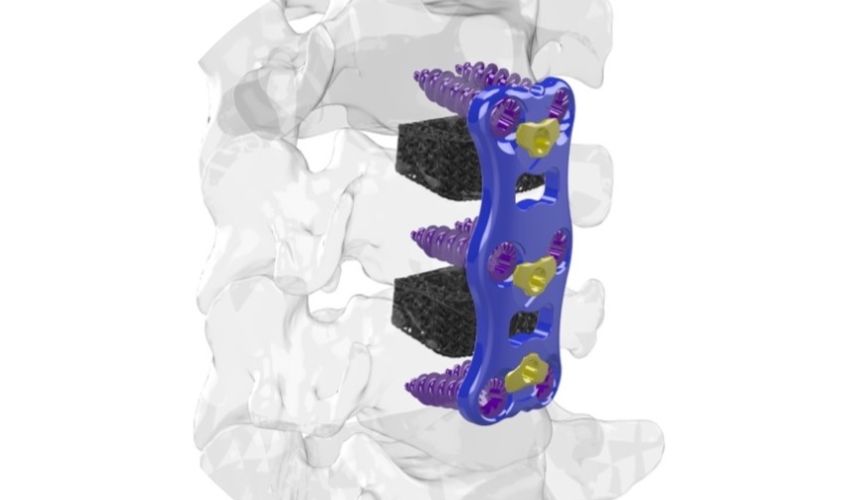 3D Printed Cervical Cage