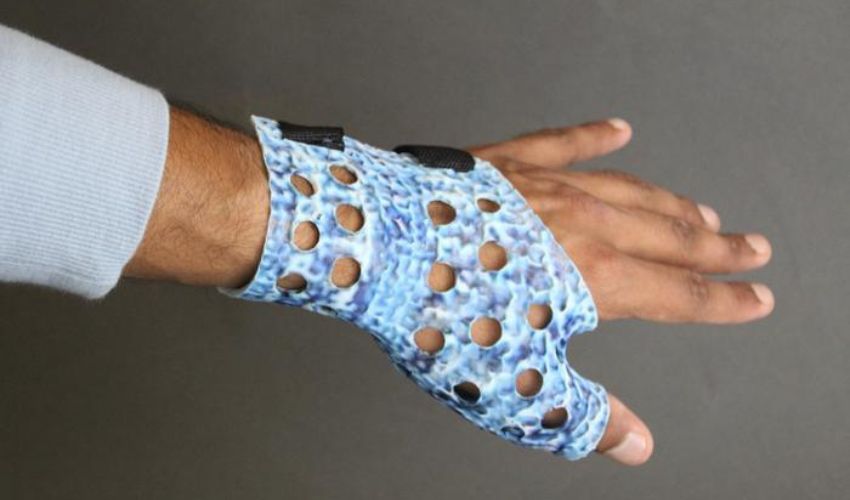 a splint 3D printed with the help of an AI program