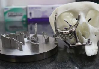 3D printed facial implant for black fungus patient