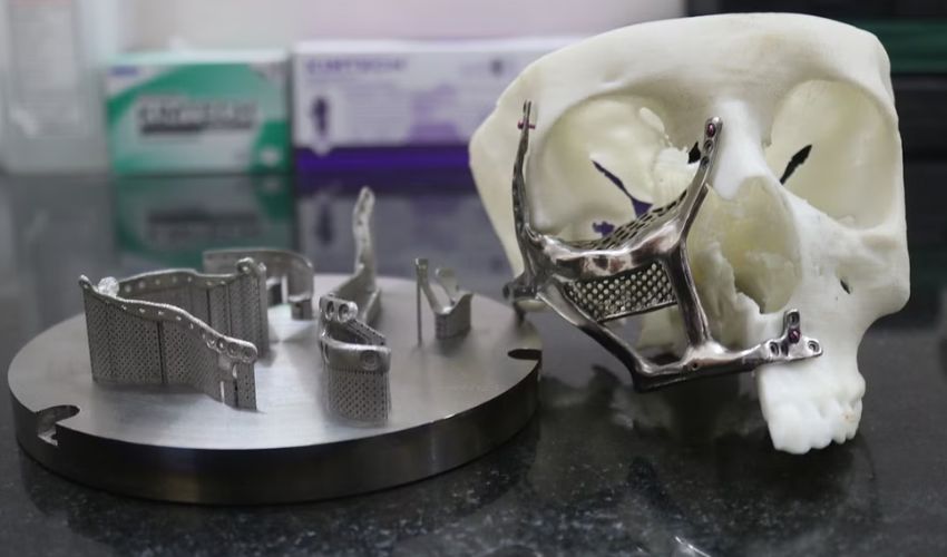 3D printed facial implant for black fungus patient
