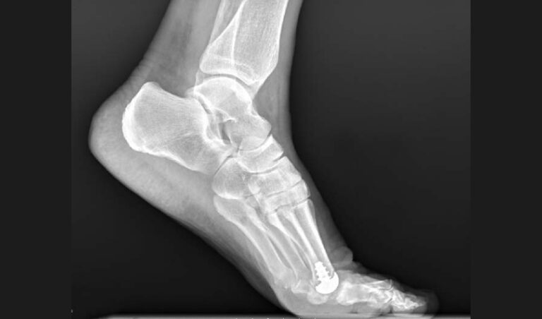 Anatomic Implants Seeks FDA Clearance for World's First 3D Printed Toe ...