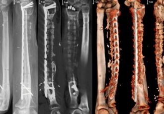 3D Printed Bone Scaffold