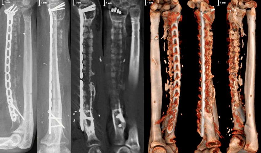 3D Printed Bone Scaffold