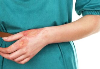 bioprinting burns