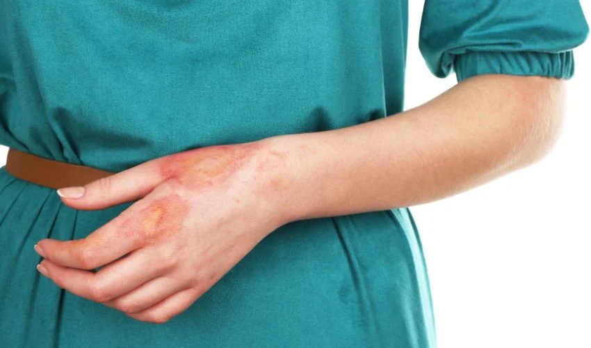 bioprinting burns
