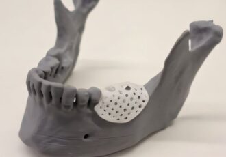 3D printed lattices for a jawbone