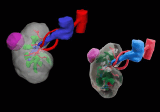3D Printed Tumors